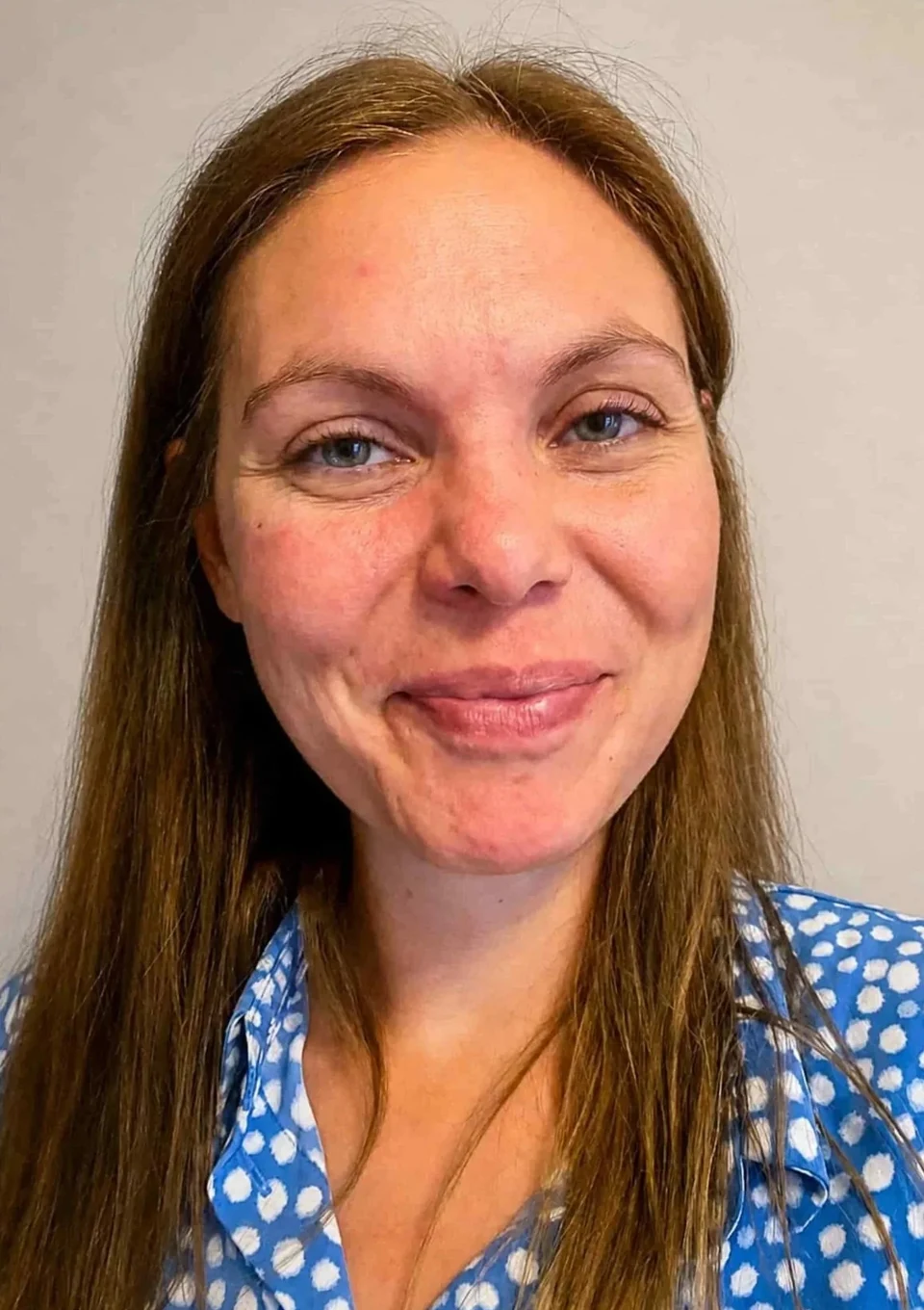Svenja nachher: beruhigtes, ebenmäßigeres Hautbild nach drei Monaten.