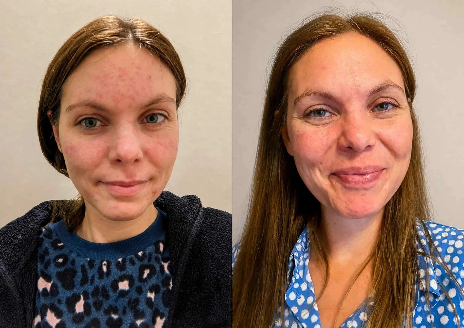 Svenja: Hautbild vorher und nach der Behandlung, Ergebnis nach 3 Monaten.