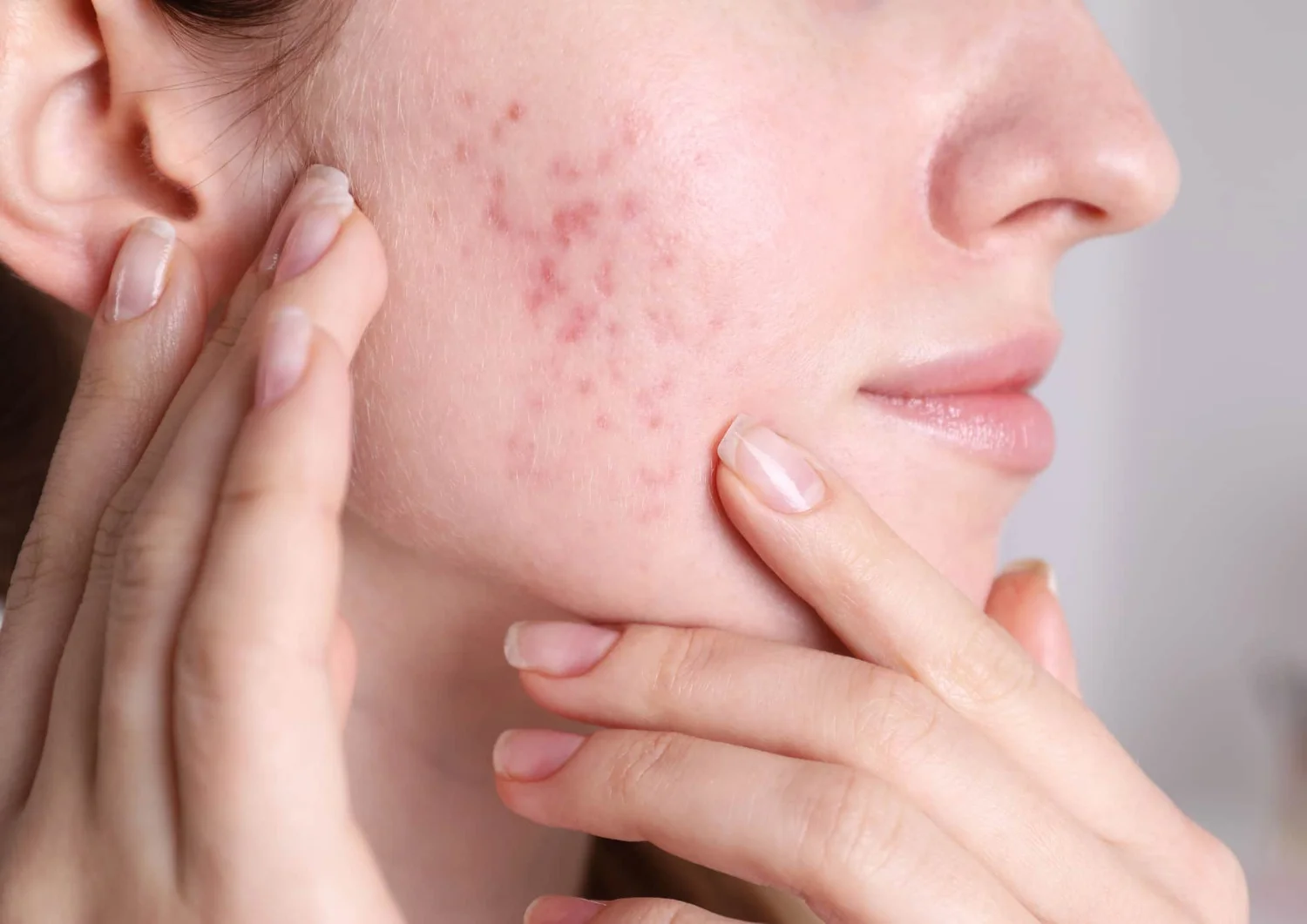 Rosacea und Rötungen: wie der Stoffwechsel das Hautbild beeinflusst