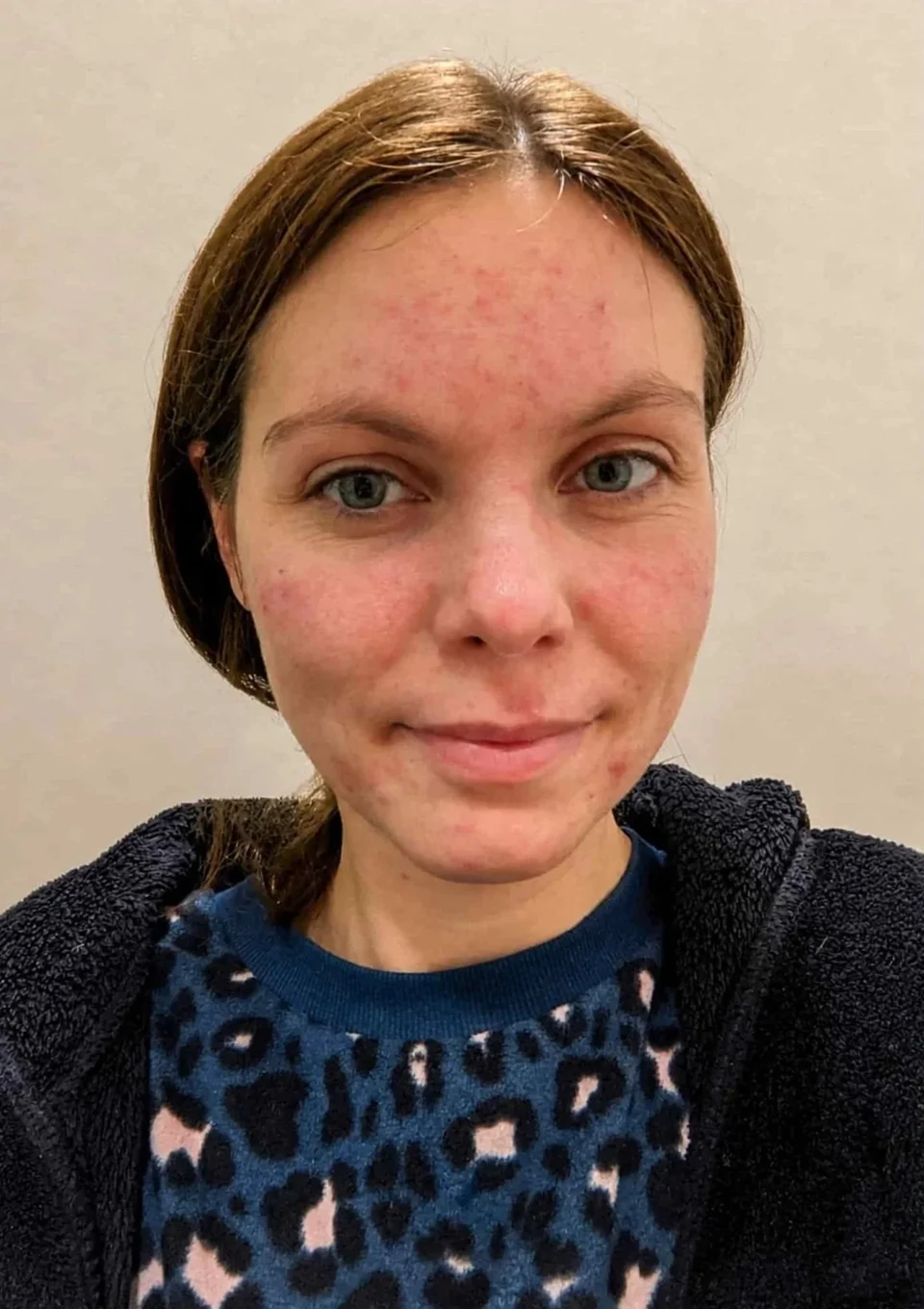 Svenja vorher: Hautbild mit Rötungen und Unreinheiten.